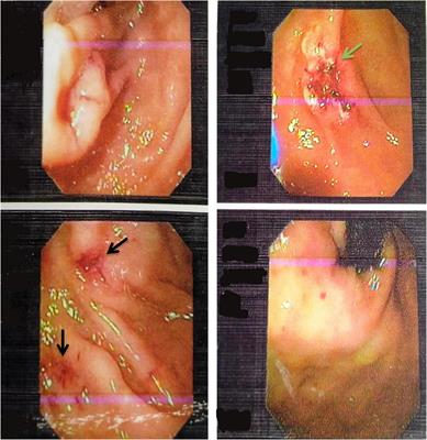 Case report: Diagnosis of hereditary hemorrhagic telangiectasia (Osler Weber Rendu Syndrome) in a 23-year-old male presented with anemia and thrombocytopenia and its response to bevacizumab